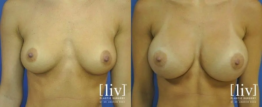 Breast Augmentation: Patient 11 - Before and After 1