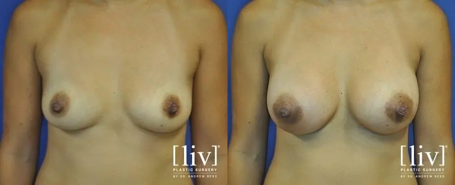 Breast Augmentation: Patient 10 - Before and After 1