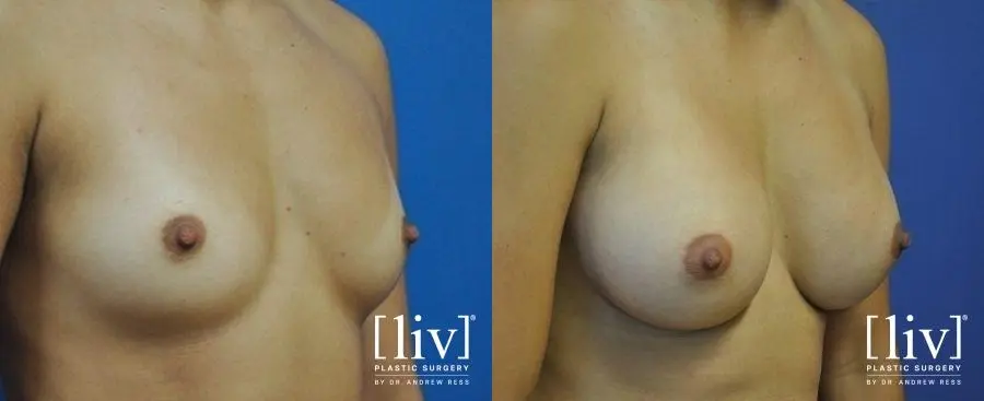 Breast Augmentation: Patient 11 - Before and After 2