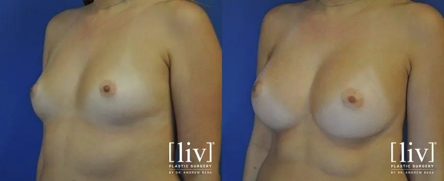 Breast Augmentation: Patient 7 - Before and After 4