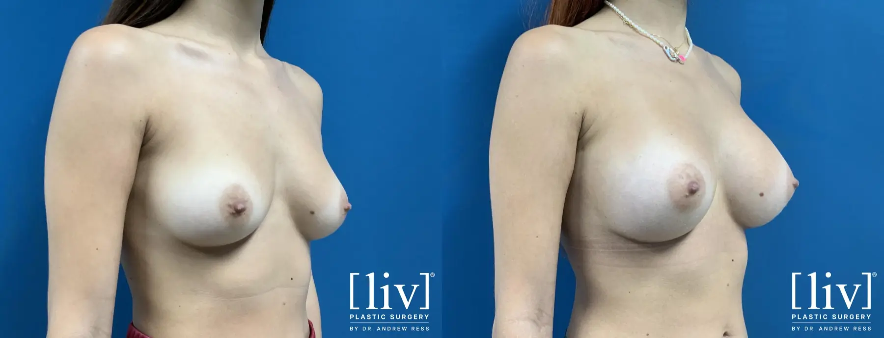 Breast Augmentation: Patient 2 - Before and After 4