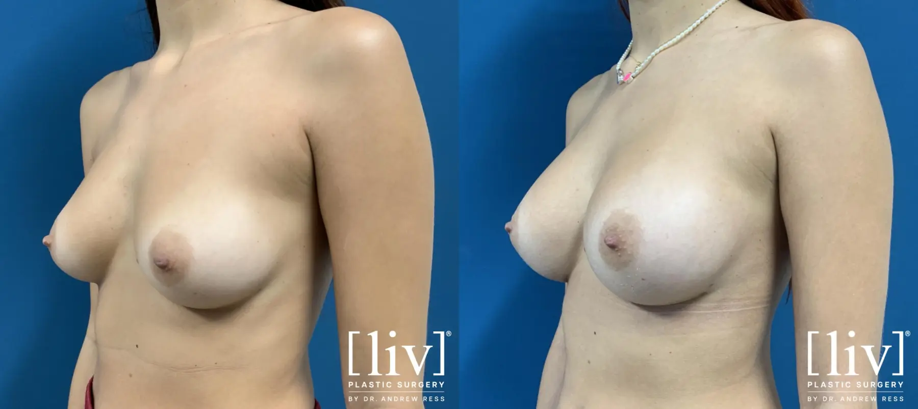 Breast Augmentation: Patient 2 - Before and After 2