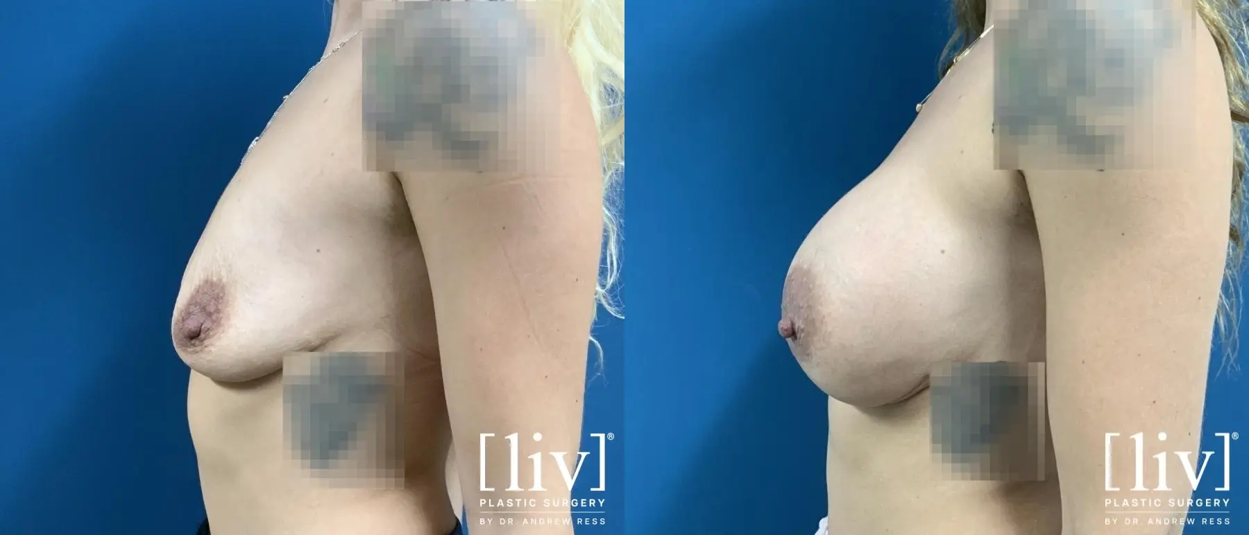 Breast Augmentation: Patient 5 - Before and After 3