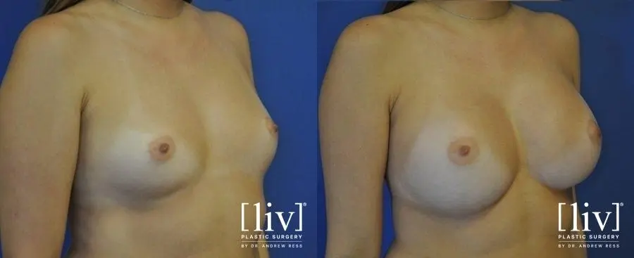 Breast Augmentation: Patient 7 - Before and After 2