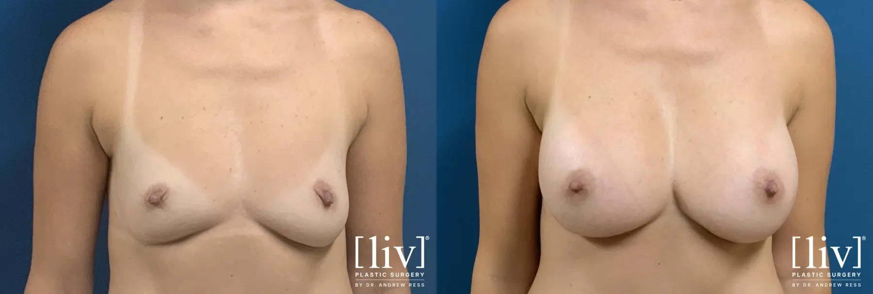 Breast Augmentation: Patient 3 - Before and After  
