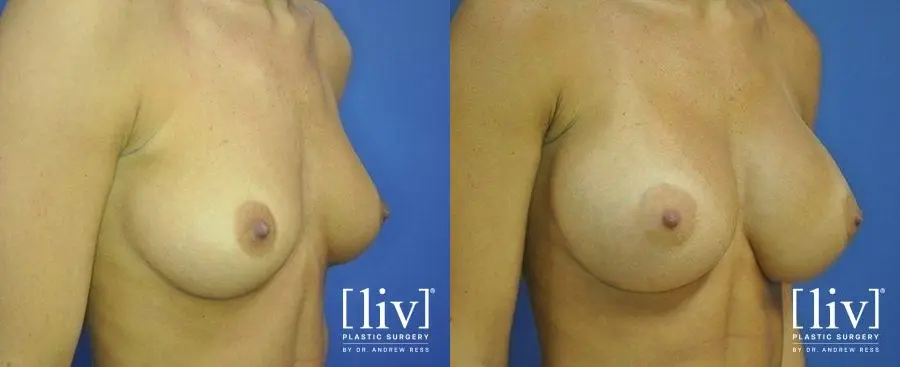 Breast Augmentation: Patient 11 - Before and After 2