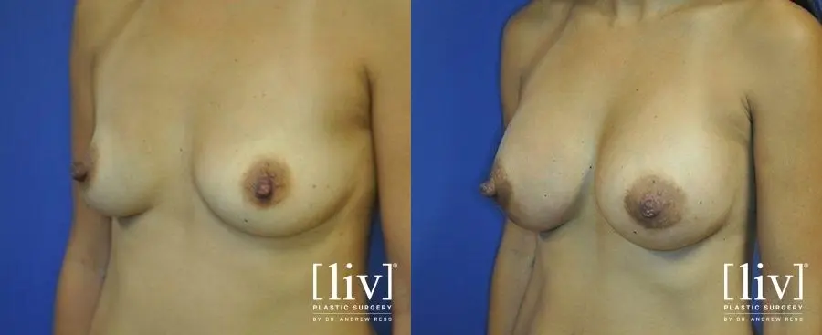 Breast Augmentation: Patient 10 - Before and After 4