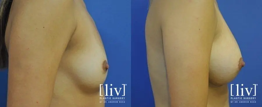 Breast Augmentation: Patient 11 - Before and After 3