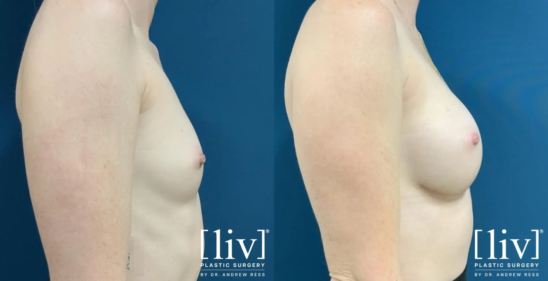 Breast Augmentation: Patient 4 - Before and After 5