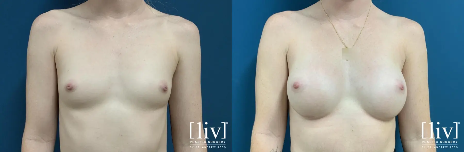Breast Augmentation: Patient 4 - Before and After 1