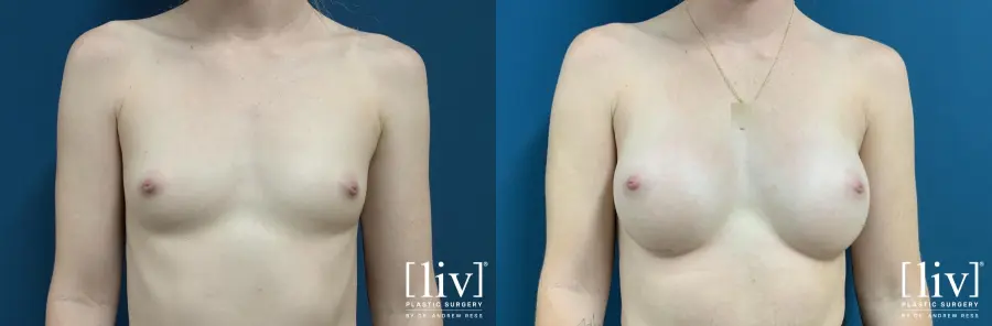 Breast Augmentation: Patient 4 - Before and After  