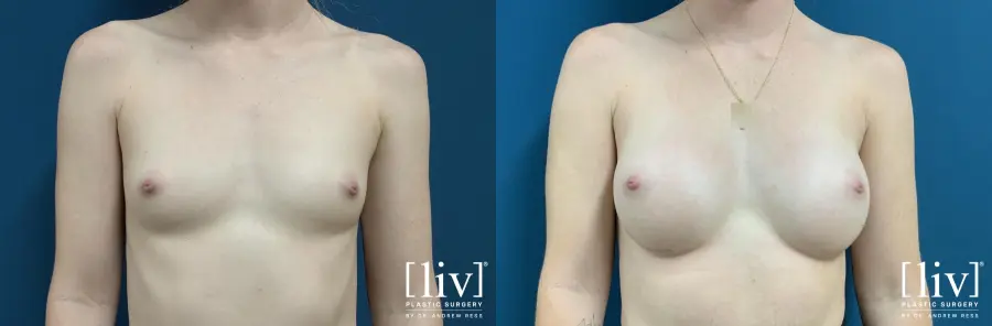 Breast Augmentation: Patient 4 - Before and After 1