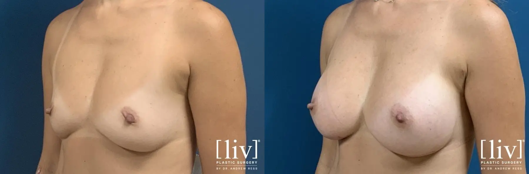 Breast Augmentation: Patient 3 - Before and After 2