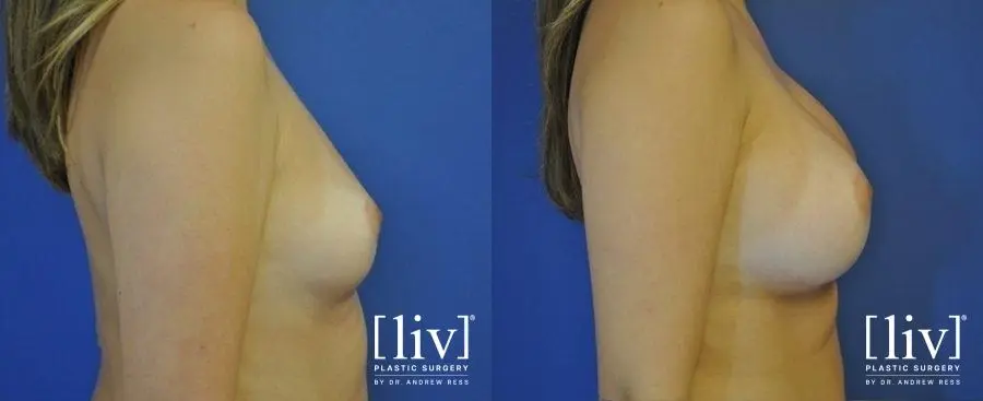 Breast Augmentation: Patient 7 - Before and After 3