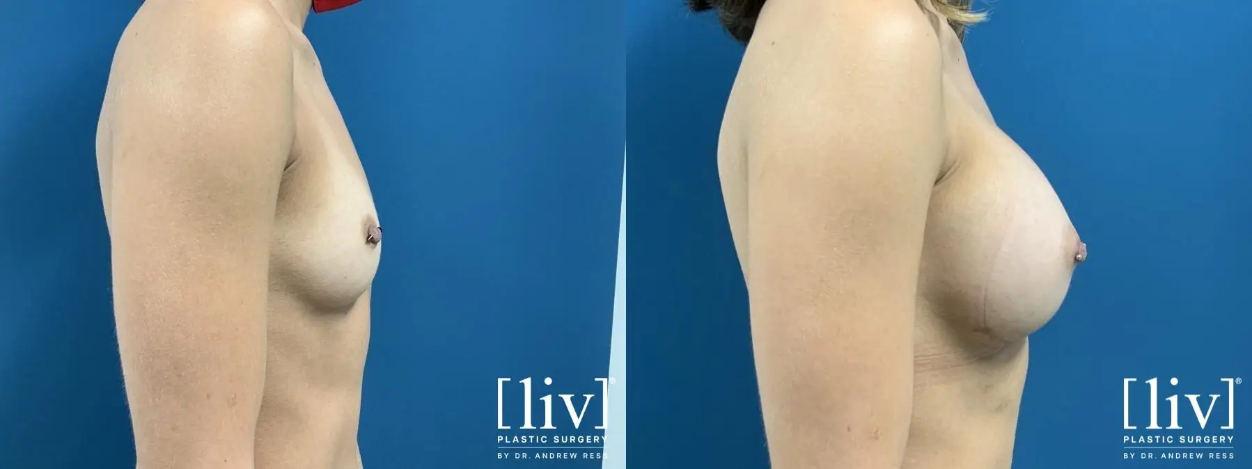 Breast Augmentation: Patient 1 - Before and After 5