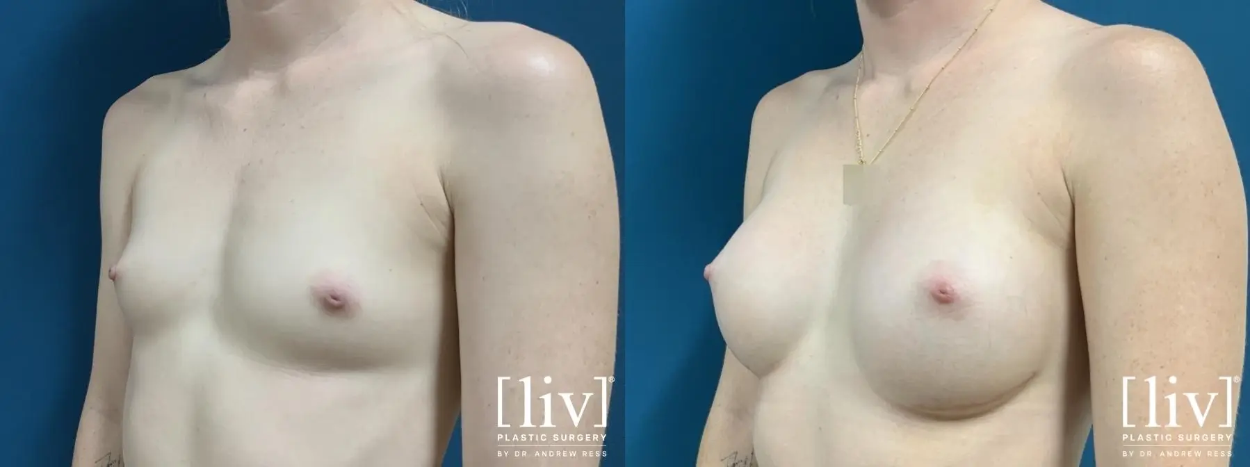 Breast Augmentation: Patient 4 - Before and After 2