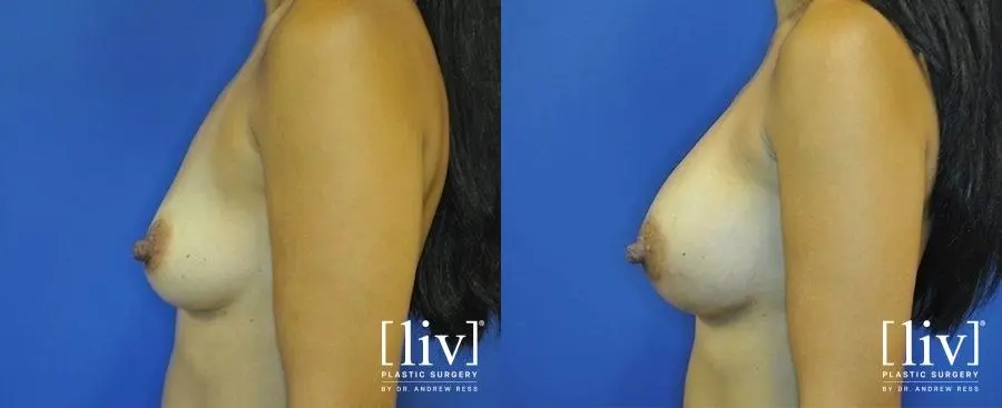 Breast Augmentation: Patient 10 - Before and After 5