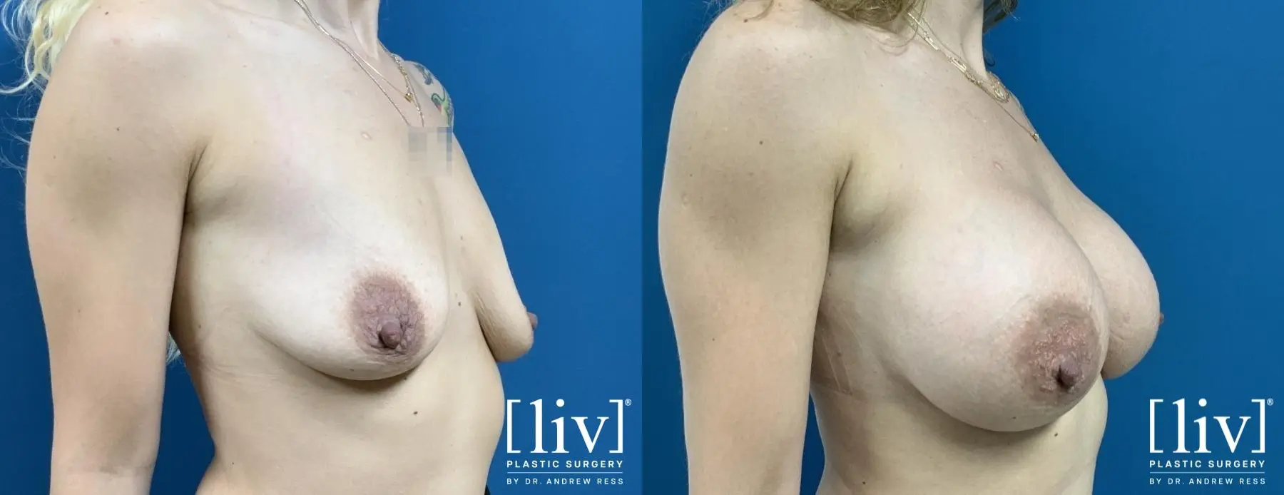 Breast Augmentation: Patient 5 - Before and After 4