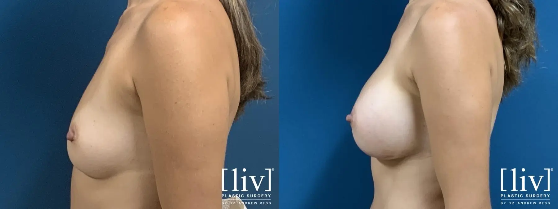 Breast Augmentation: Patient 3 - Before and After 3