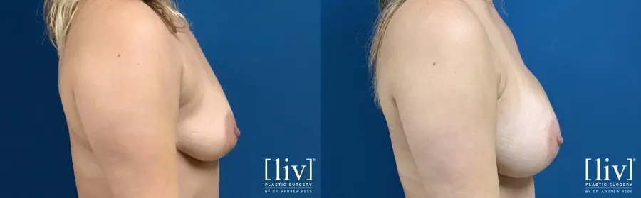 Breast Augmentation: Patient 6 - Before and After 3