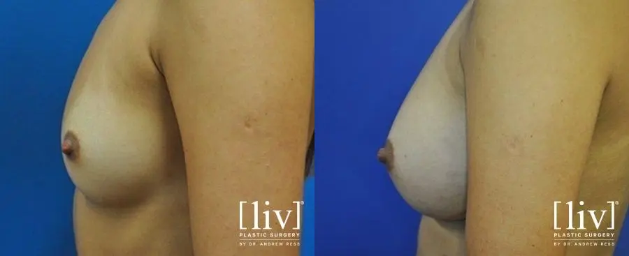 Breast Augmentation: Patient 12 - Before and After 4