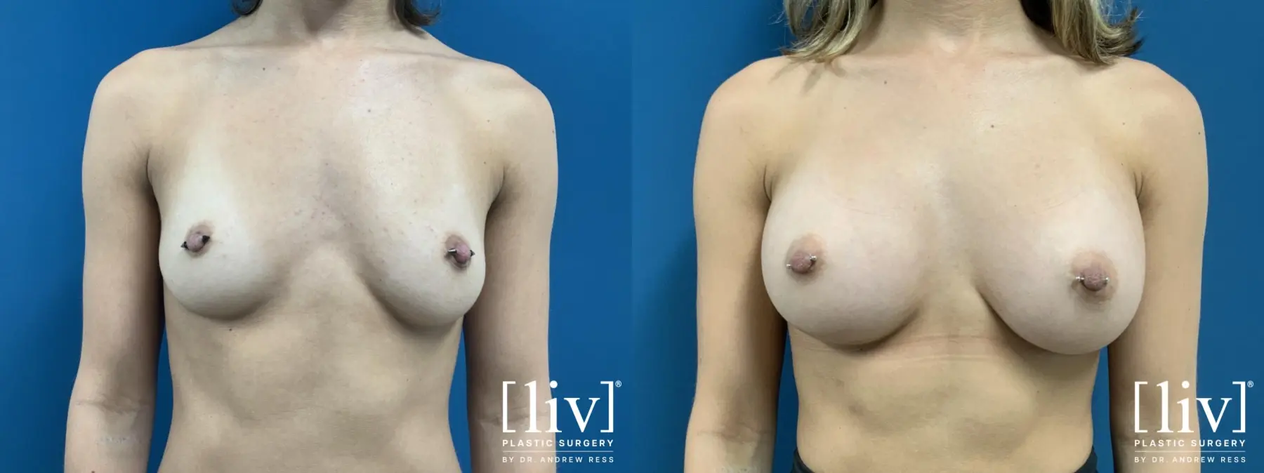 Breast Augmentation: Patient 1 - Before and After  