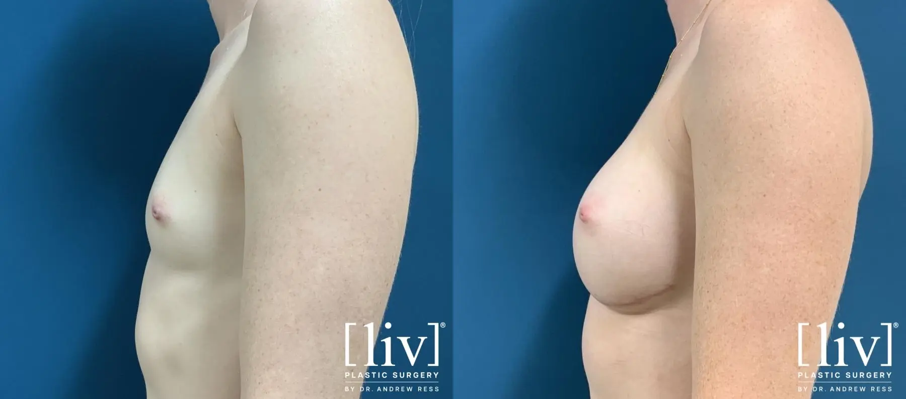 Breast Augmentation: Patient 4 - Before and After 3