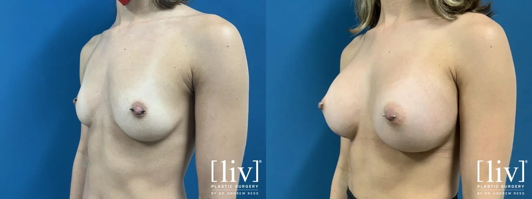 Breast Augmentation: Patient 1 - Before and After 2