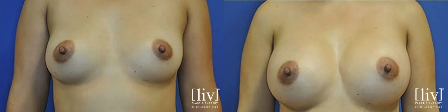 Breast Augmentation: Patient 9 - Before and After 1