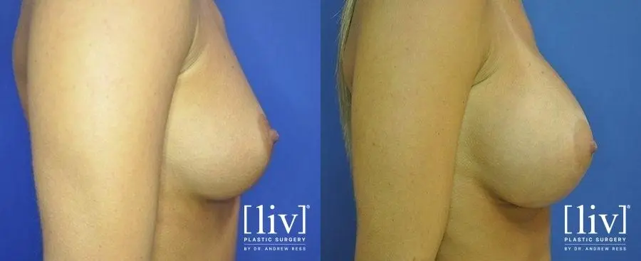 Breast Augmentation: Patient 11 - Before and After 3