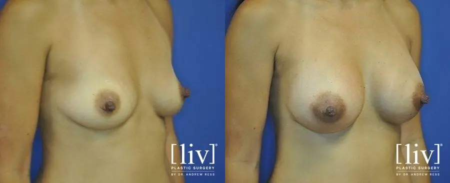 Breast Augmentation: Patient 10 - Before and After 2