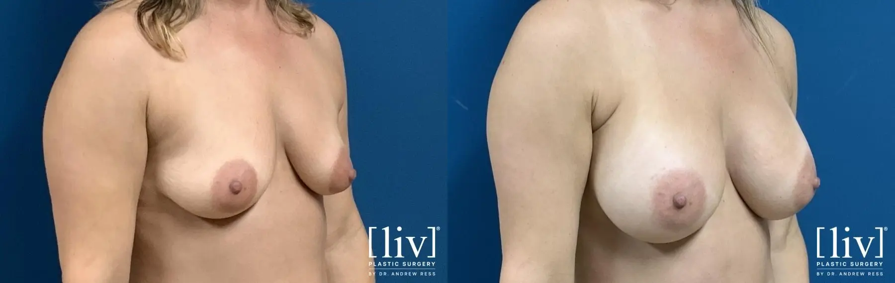 Breast Augmentation: Patient 6 - Before and After 2