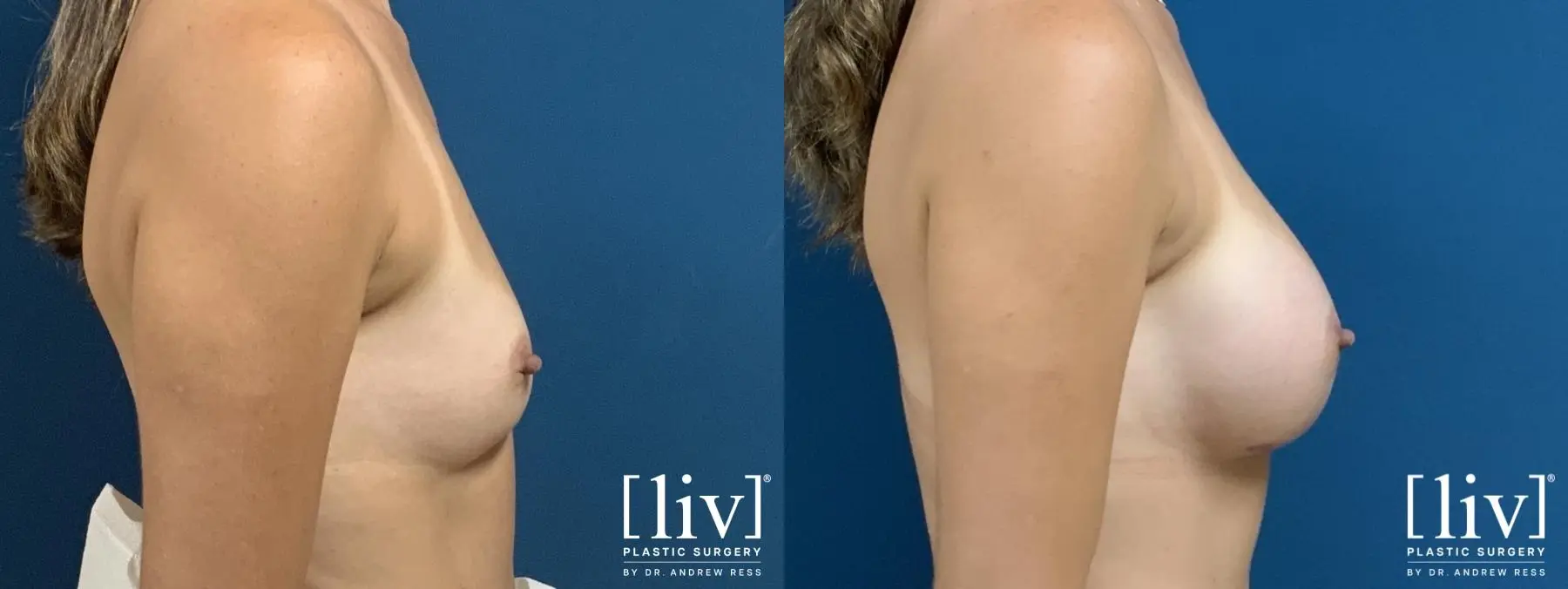 Breast Augmentation: Patient 3 - Before and After 5