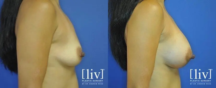 Breast Augmentation: Patient 10 - Before and After 3