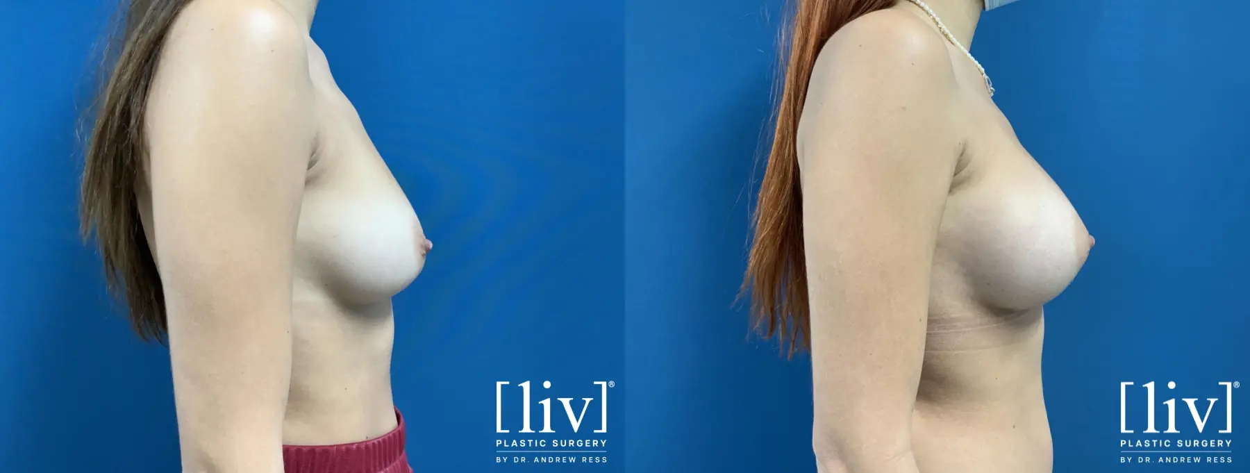 Breast Augmentation: Patient 2 - Before and After 5