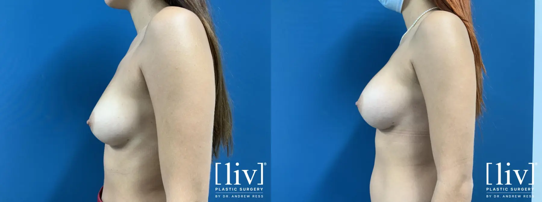 Breast Augmentation: Patient 2 - Before and After 3