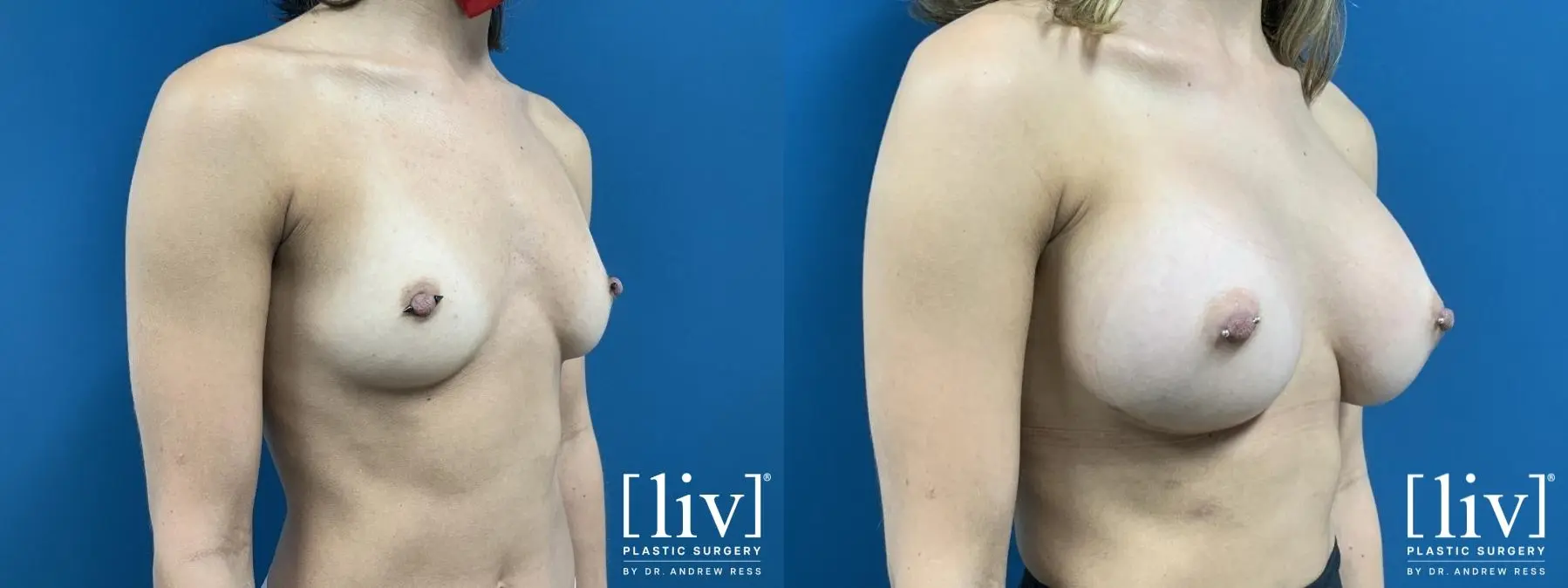 Breast Augmentation: Patient 1 - Before and After 4