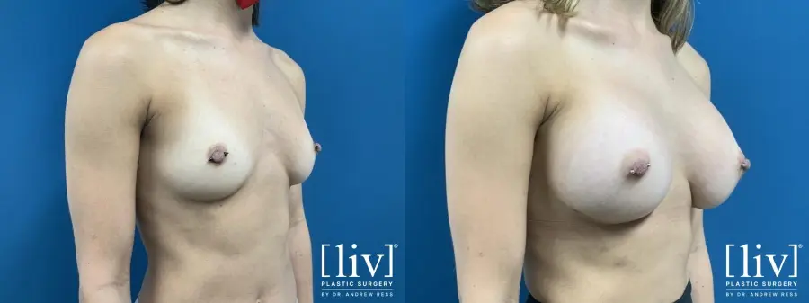 Breast Augmentation: Patient 1 - Before and After 4
