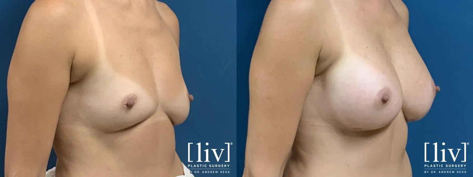 Breast Augmentation: Patient 3 - Before and After 4