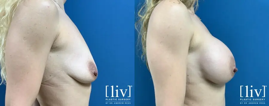 Breast Augmentation: Patient 5 - Before and After 5