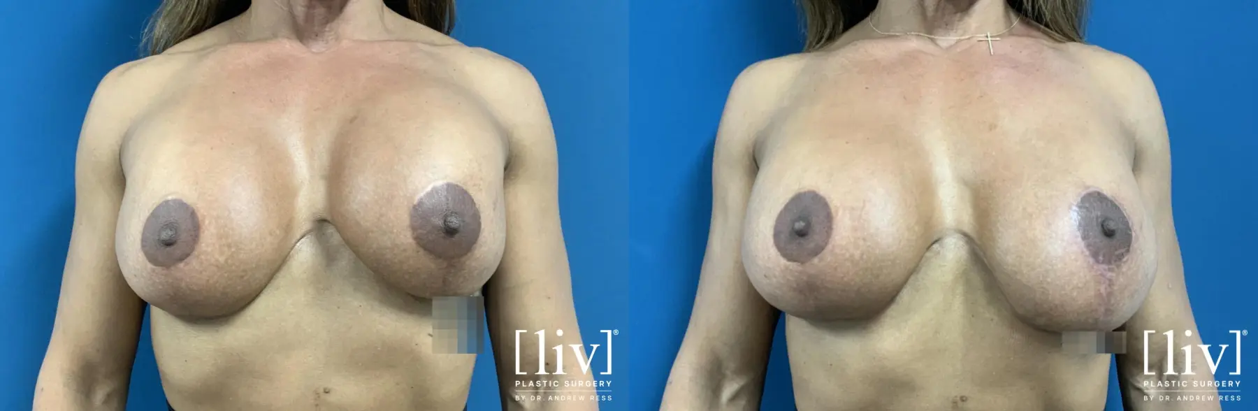Breast Implant Exchange and Capsulectomy - Before and After 1