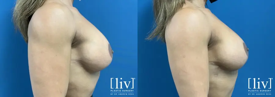 Capsulectomy and Implant Exchange - Before and After 5