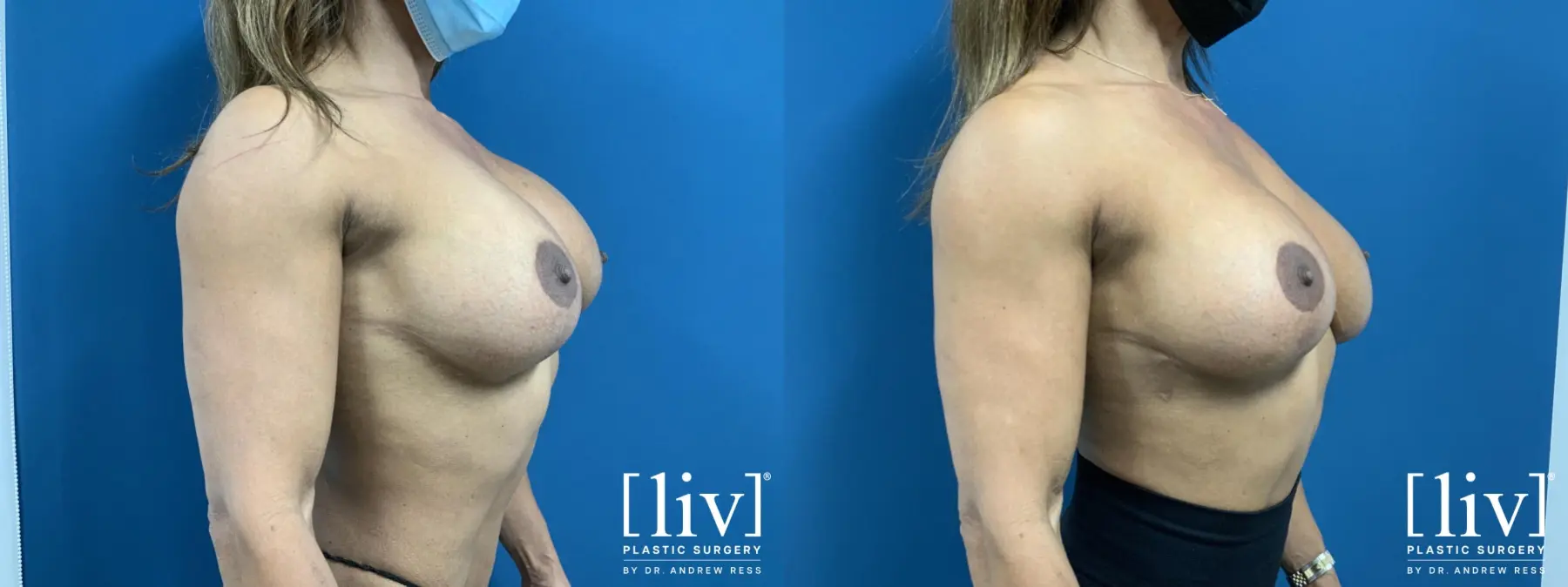 Breast Implant Exchange and Capsulectomy - Before and After 4