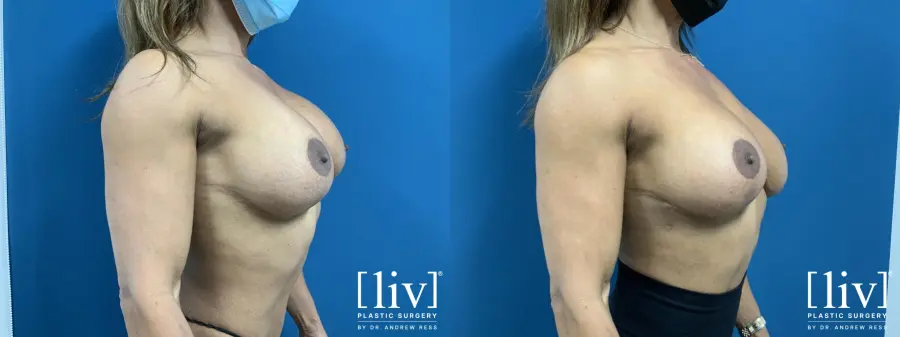 Capsulectomy and Implant Exchange - Before and After 4