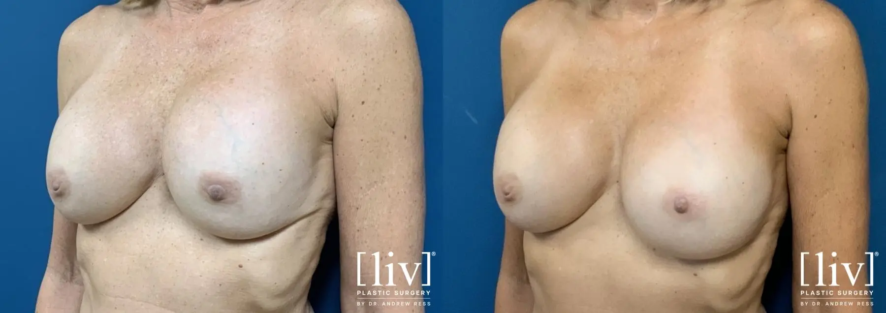 Breast Implant Exchange and Capsulotomy - Before and After 3