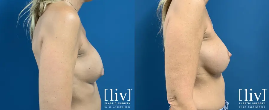 Breast Implant Exchange - Before and After 5