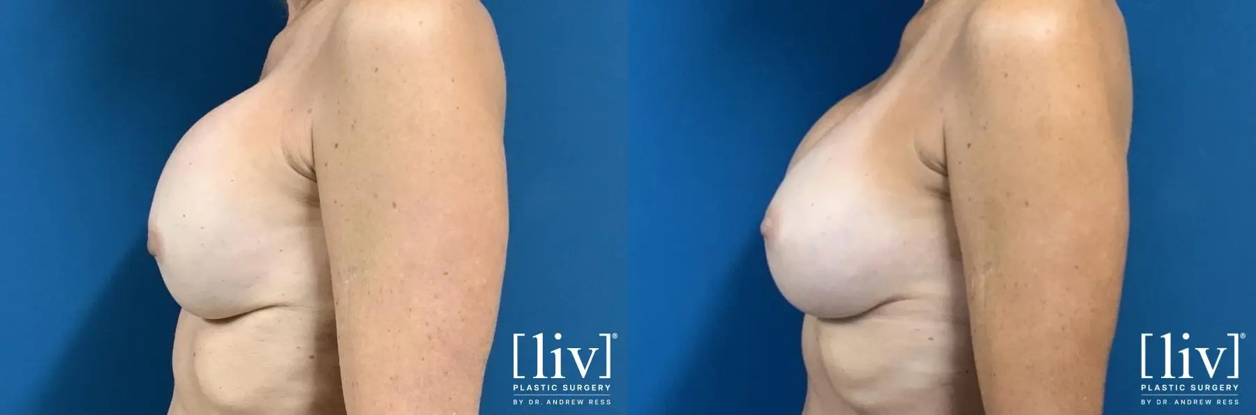 Breast Implant Exchange and Capsulotomy - Before and After 4