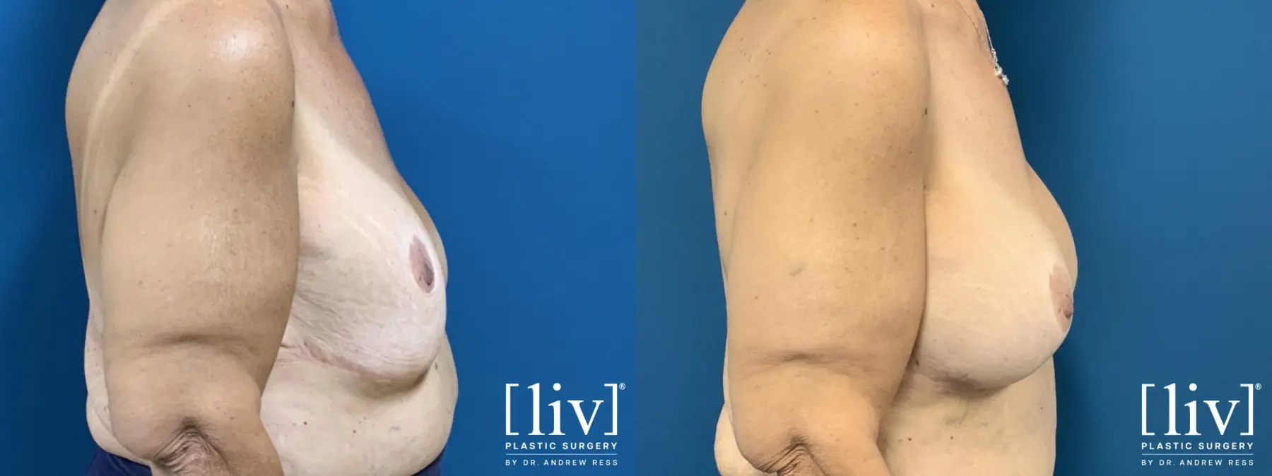 Breast Implant Exchange and Repositioning - Before and After 5