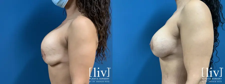 Breast Lift and Implant Exchange - Before and After 3
