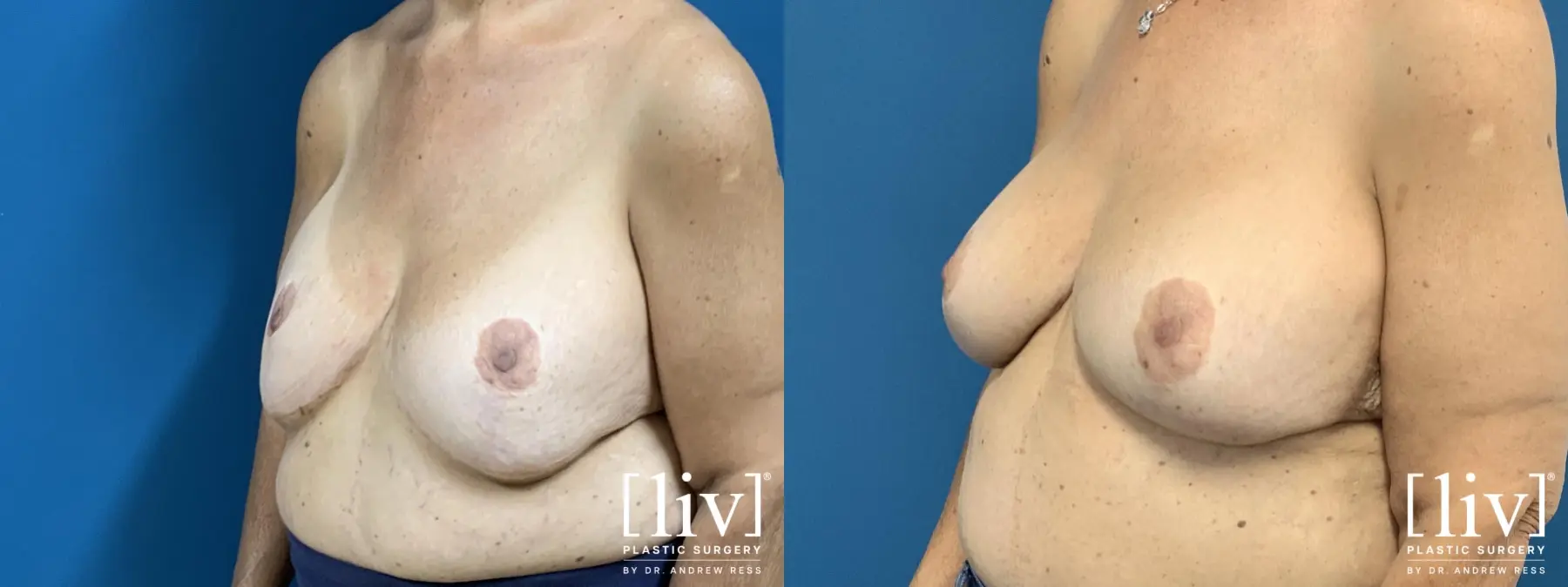 Breast Implant Exchange and Repositioning - Before and After 2